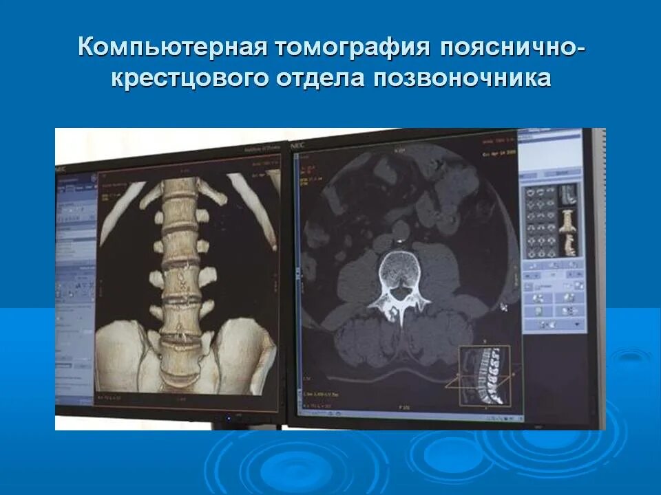 Рентген крестцового отдела позвоночника подготовка. Мрт исследование пояснично-крестцового отдела позвоночника. Снимок кт пояснично-крестцового отдела. Снимки кт пояснично крестцового отдела позвоночника. К-Т поясничного кресцово отдела.