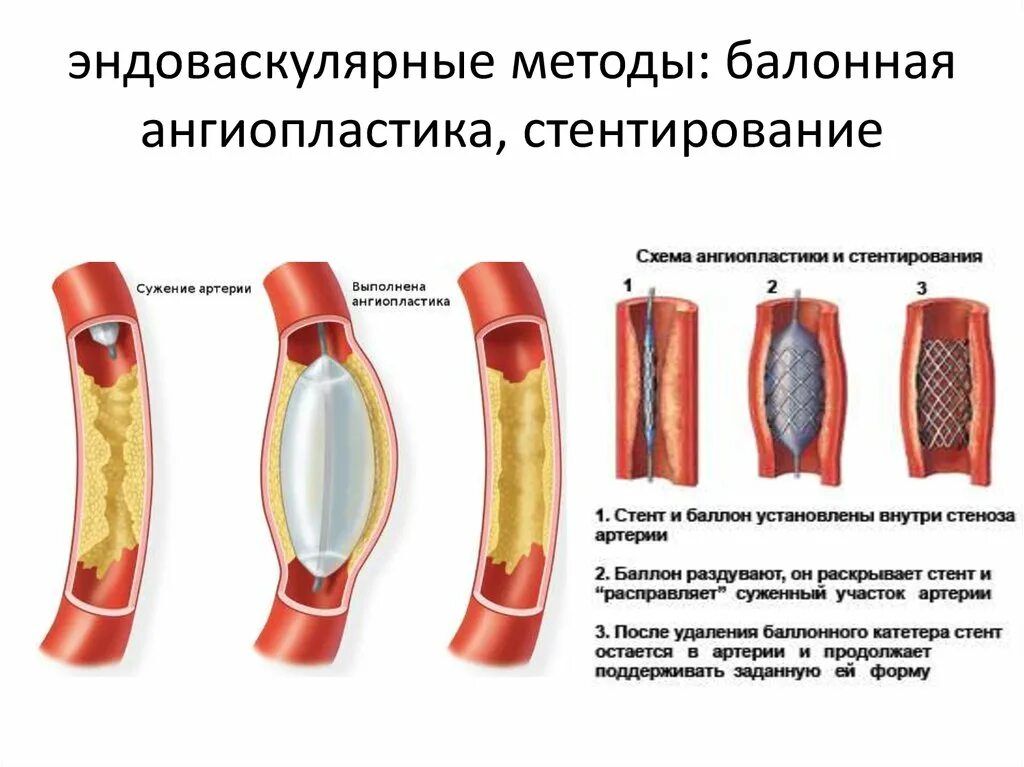 Стентирование рекомендации. Баллонная ангиопластика и стентирование артерий сердца. Эндоваскулярная баллонная ангиопластика. Рентген эндоваскулярная баллонная ангиопластика. Стентирование сосудов эндоваскулярное.