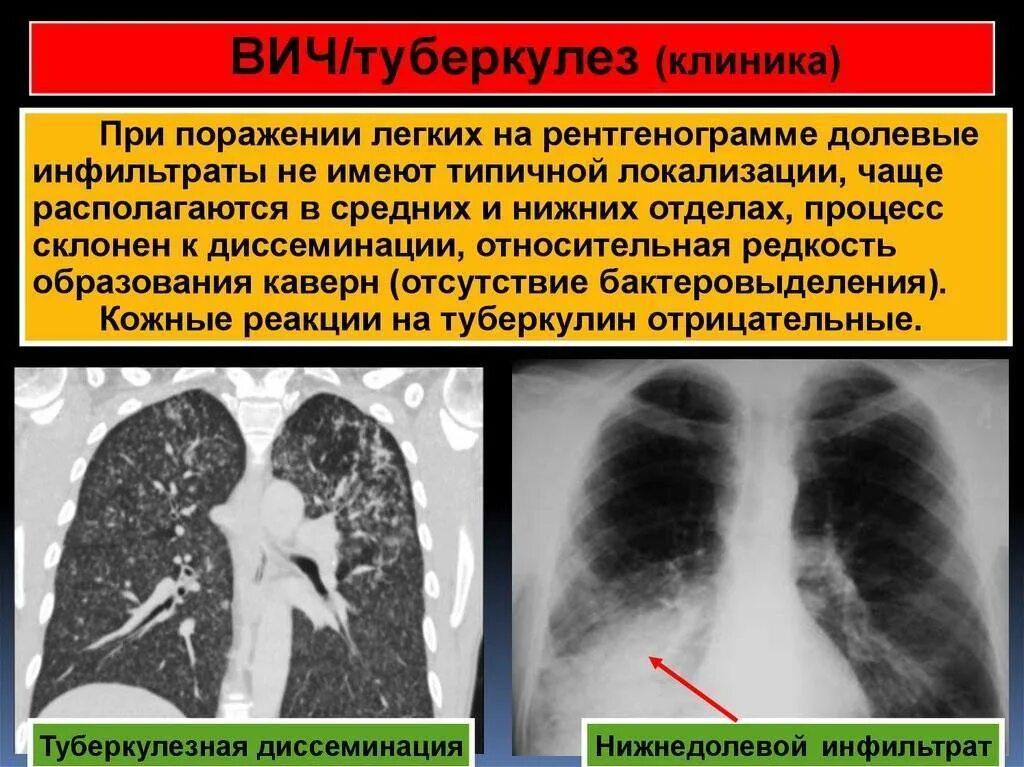 Диссеминация туберкулеза на рентгене. Диссеминированный туберкулез на кт. Туберкулез поражение легких.