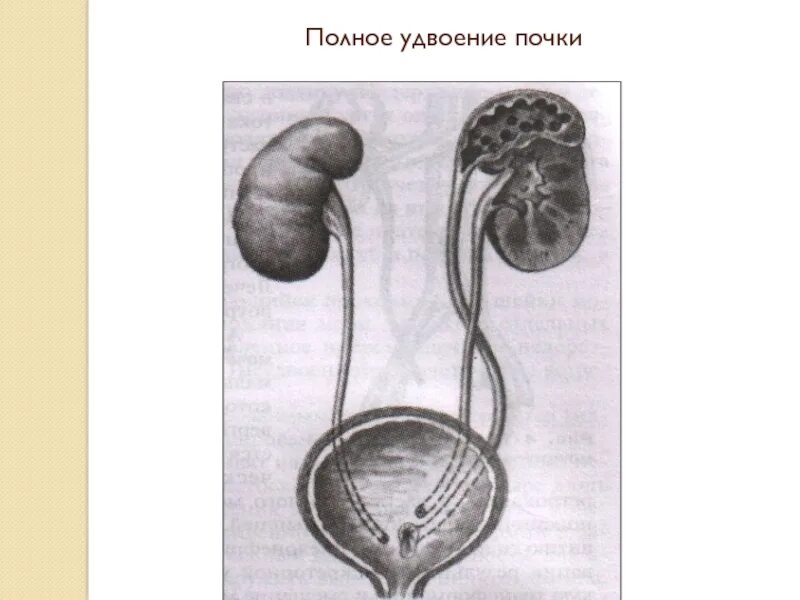 Неполное удвоение чашечно-лоханочной почки. Удвоение чашечно-лоханочной системы. Врожденные аномалии развития чашечно лоханочной системы почки. Удвоение члс почки. Почка удвоена.