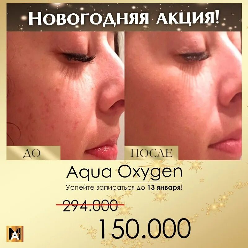 Совместимость филлеров и ботокса. Ботокс. Филлер и ботокс различия таблица. Ботокс и филлеры разница. Массаж лица до и после.