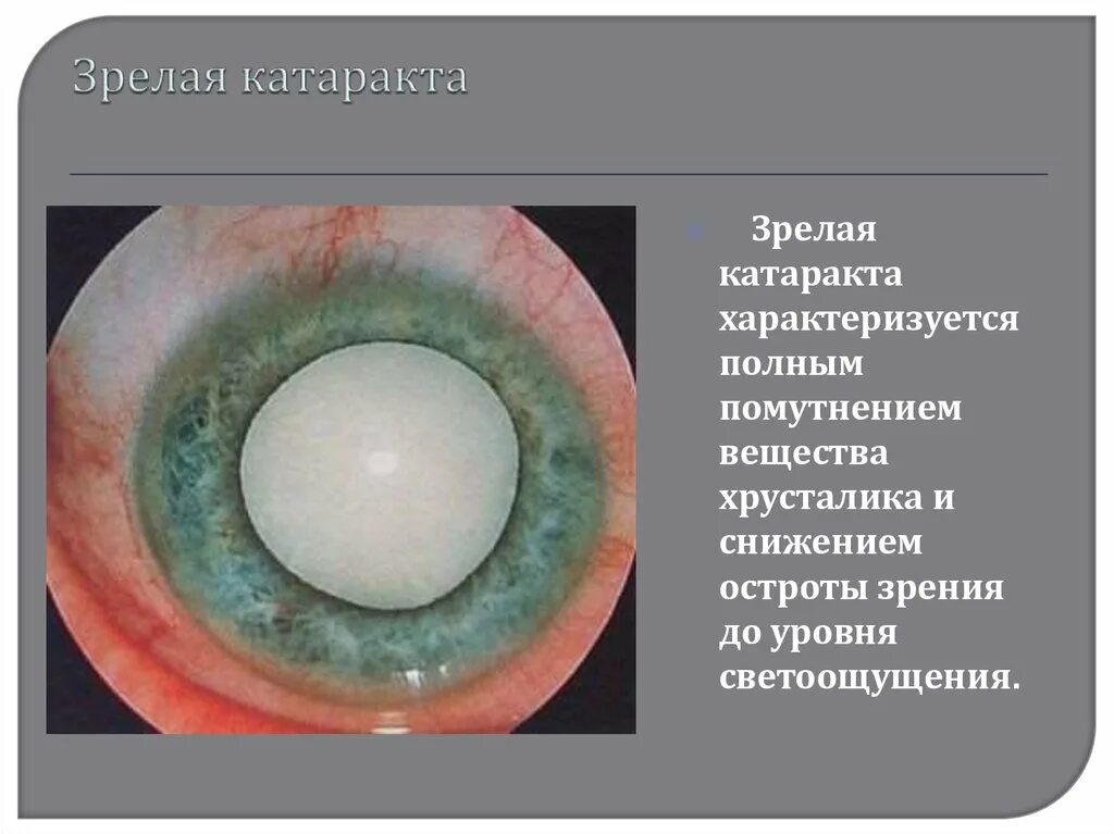 Лучевая радиоционнаякатаракта. Радиационная катаракта. 1 признаки катаракты