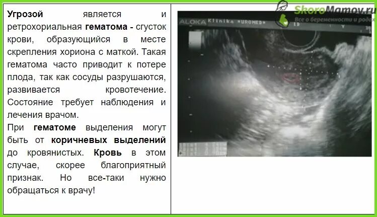 Признаки ретрохориальной гематомы при беременности 6-7 недель. УЗИ беременности на ранних сроках. 8 недели задержки