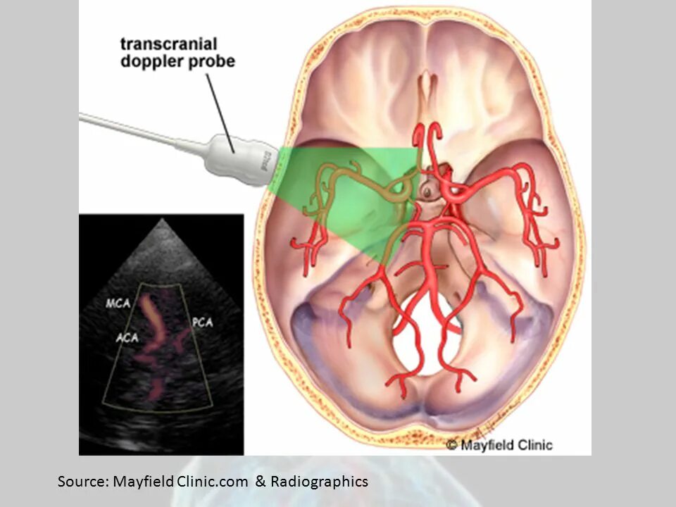 Транскраниальная ультразвуковая допплерография. Транскраниальный датчик УЗИ. Допплеровское сканирование сосудов шеи. Транскраниальная допплерография сосудов головного. Транскраниальные артерии и вены
