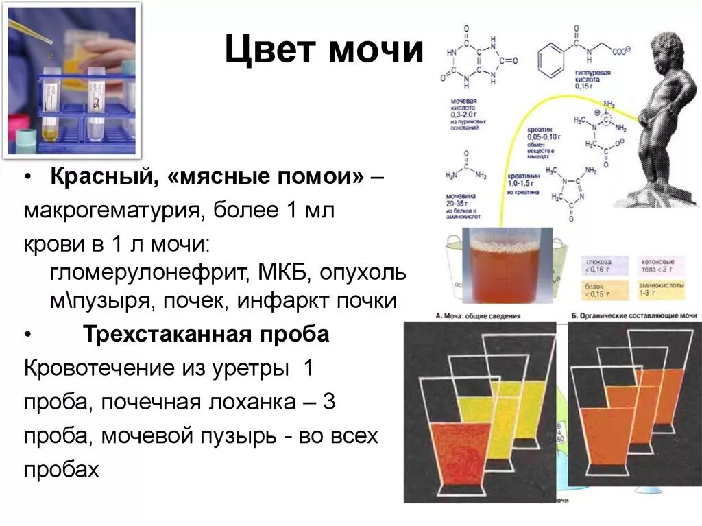 Трехстаканная проба мочи. Цвет мочи цвет мясных помоев заболевания. Гломерулонефрит моча цвета мясных помоев. Моча цвета мясных помоев характерна для. Цвет мочи типа мясных помоев характерен для.