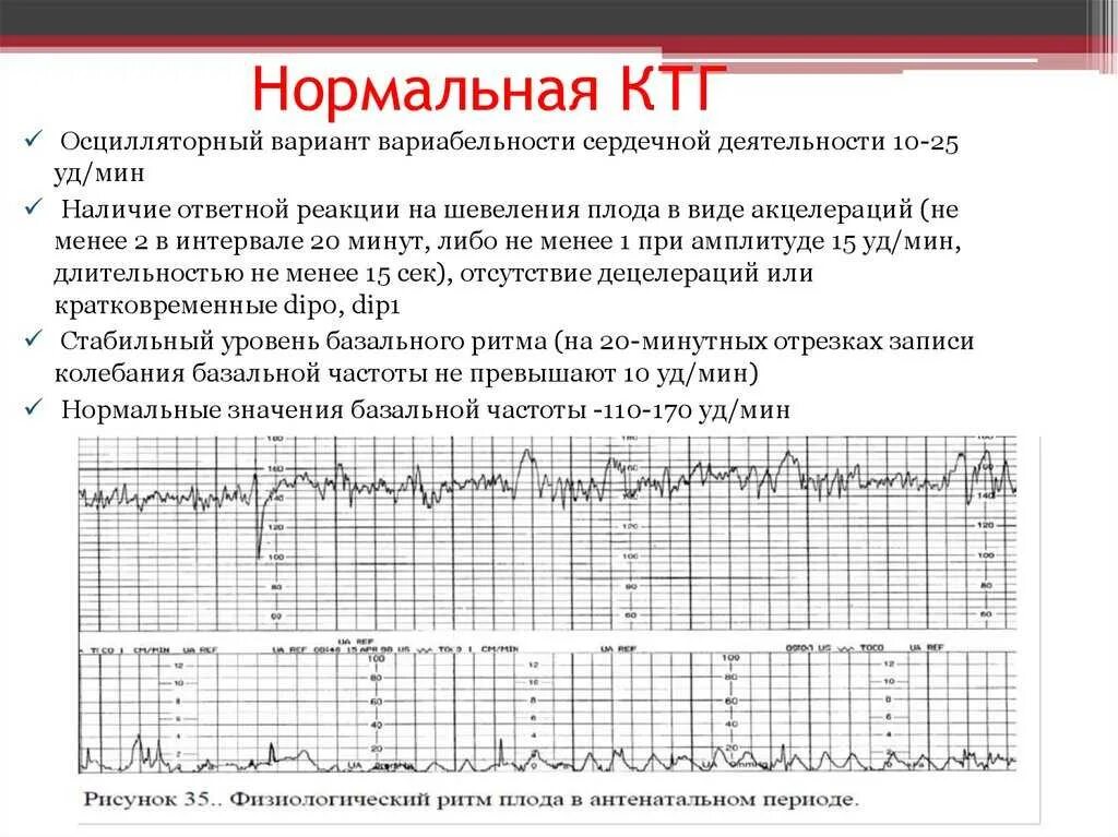 Сколько по времени делают ктг при беременности. Нормальная диаграмма ктг. базальный ритм на ктг норма. кардиотокография плода норма. нормальное сердцебиение плода в родах.