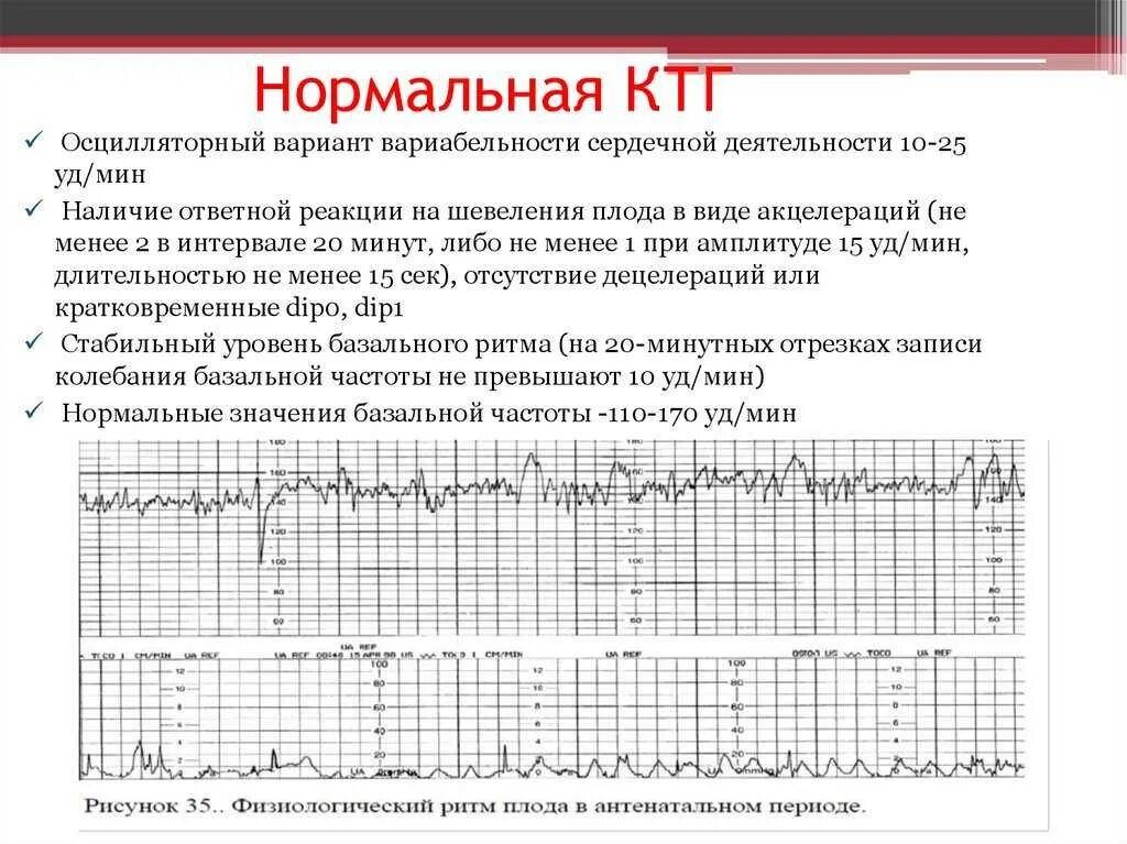 Как определить сердцебиение ребенка. КТГ мониторинг при беременности. Нормальная диаграмма КТГ. Норма ЧСС плода на КТГ. Нормальные показатели КТГ плода.