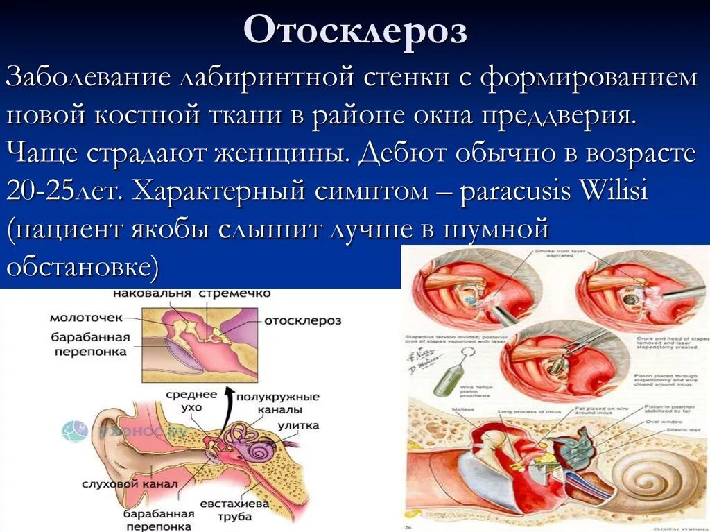 Смешанная тугоухость отосклероз. Отосклероз слухового прохода. Кондуктивный отосклероз. Отосклероз симптомы. Болезнь внутреннего уха