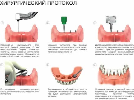 Импланты отзывы врачей