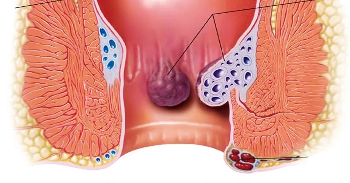 Тромбированный узел геморрой. Внутренний и внешний геморрой. Внешний геморроидальный узел. Боли внутри заднего прохода