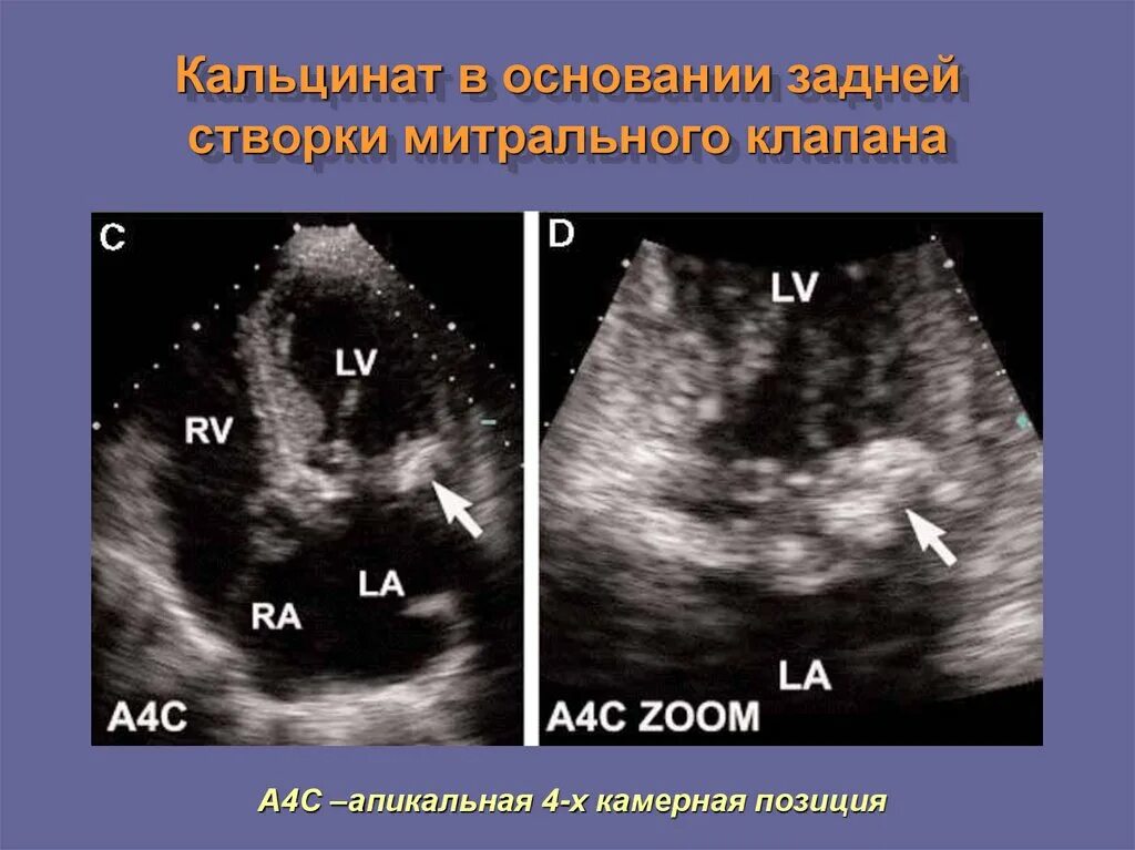 Кальциноз митрального клапана. Створки аортального клапана на ЭХОКГ. Кальциноз митрального клапана ЭХОКГ. Створки митрального клапана на ЭХОКГ. Задняя створка митрального клапана Эхо кг.