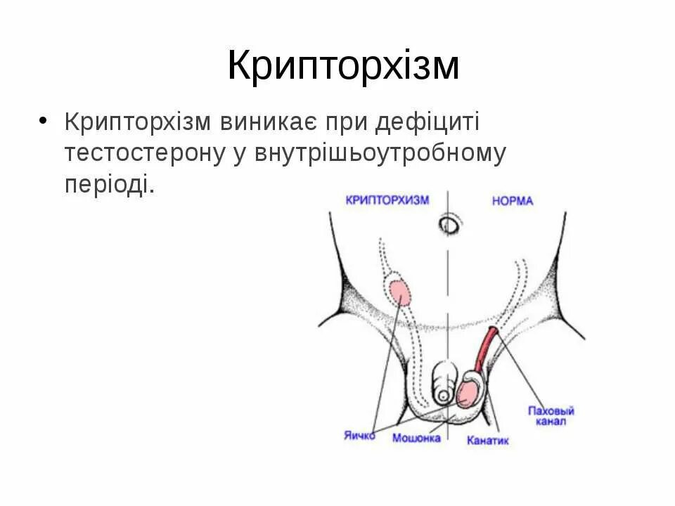 Крипторхизм лечение. Опущение яичка в мошонку.