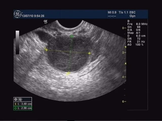 Можно ли спутать кисту. Эндометриоидная киста яичника на УЗИ. Эндометриоидные кисты яичников УЗИ. Эндометриоидные кисты яичника на УЗИ. Фолликулярная киста на УЗИ.