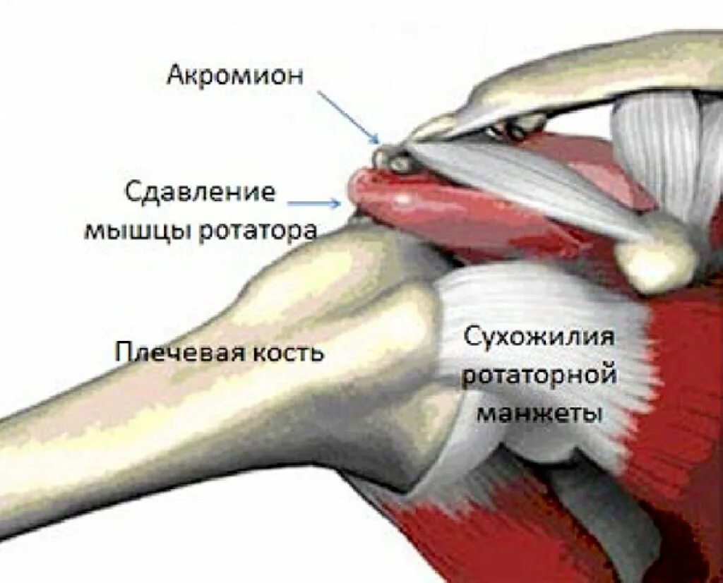 Импинджмент сухожилия надостной мышцы. Субакромиальный импиджмент плечевого сустава. Импинджмент надостной мышцы плечевого сустава. Синдром сдавливания ротатора плеча.