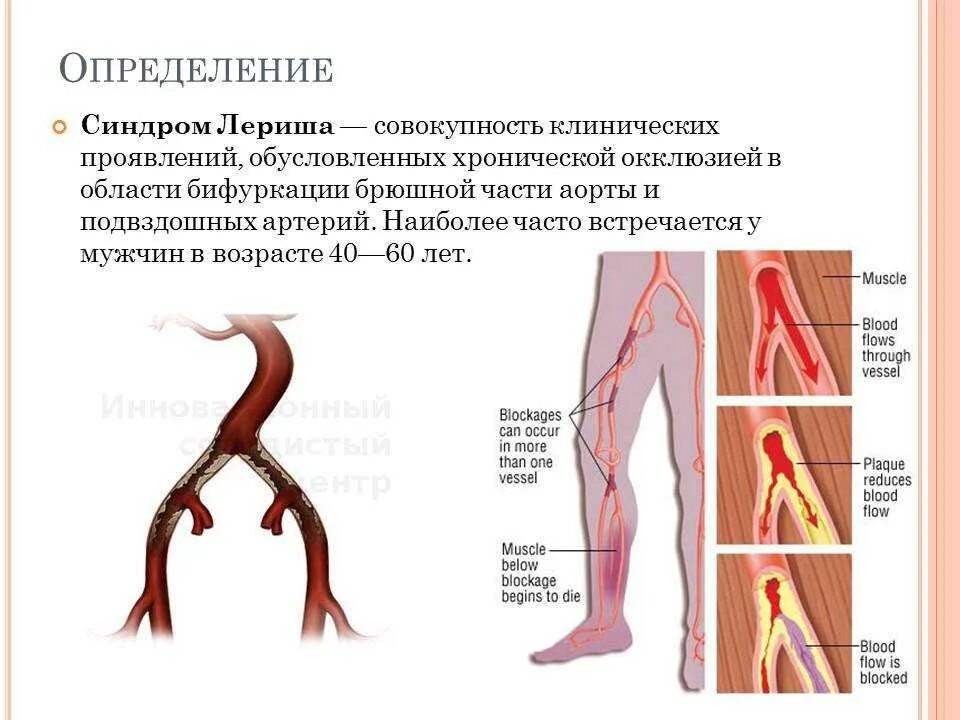 Подвздошный тромбоз симптомы. Подвздошный тромбоз симптомы