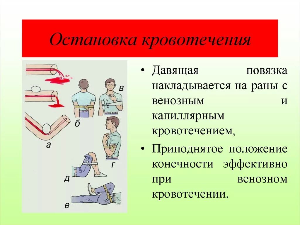 Остановка кровотечения. Способы остановки кровотечения. Остановкакровотеечния. Остановка кровотечени. Эффективный и доступный метод остановки венозного