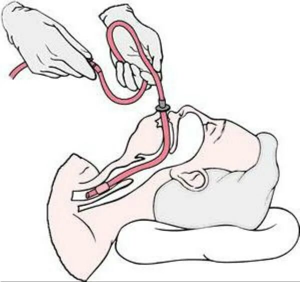 Промывание через зонд. Промывание желудка тонким зондом. Промывание желудка с интубацией трахеи. Интубация лёгких промывание. Зондовые манипуляции промывание желудка.