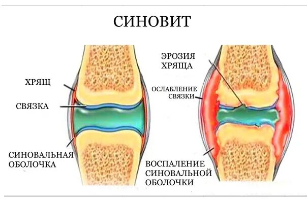 Синовит синовиальная оболочка. Синовит это воспаление синовиальной. Синовит коленного сустава у ребенка 8 лет. Синовиальная оболочка коленного сустава норма.