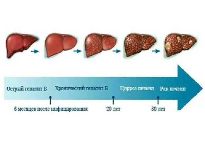 Гепатит на сколько лет. Хронический гепатоз печени исход. Алкогольный цирроз печени диагноз. Печень с алкогольным циррозом печени. Острый и хронический алкогольный гепатит.