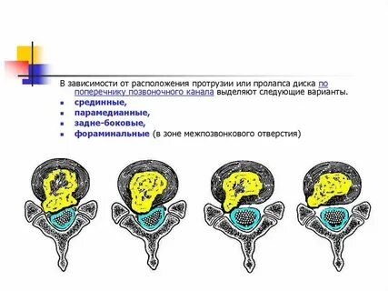Медианная протрузия