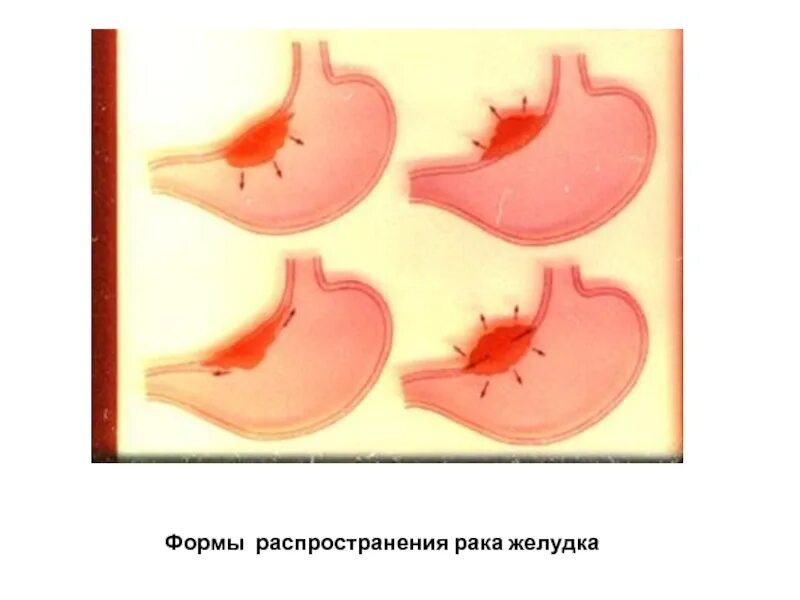 Салфетки язвы. Пенетрация язвенной болезни желудка. Пенетрация осложнение ЯБЖ. Осложнения пенетрирующей язвы желудка. Осложнения язвы желудка Пенетрация.