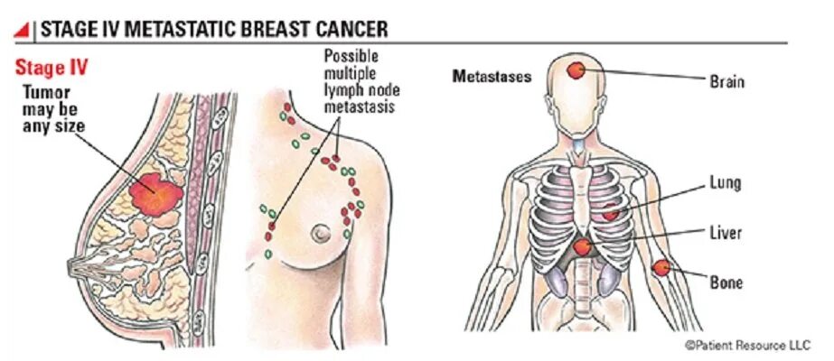 С метастазами 4 степени сколько живут. Карцинома молочной железы 4 стадия. Опухоль 4 степени груди. Онкология грудной железы 4 стадии. Метастазирование опухолей молочной железы.