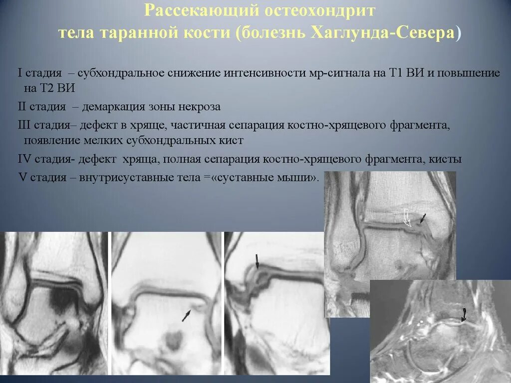 Рассекающий остеохондрит надколенника кт. Хондромаляция надколенника outerbridge. Остеохондральное повреждение бедренной кости. Остеохондральное повреждение бедренной кости. Остеохондральное повреждение бедренной кости.
