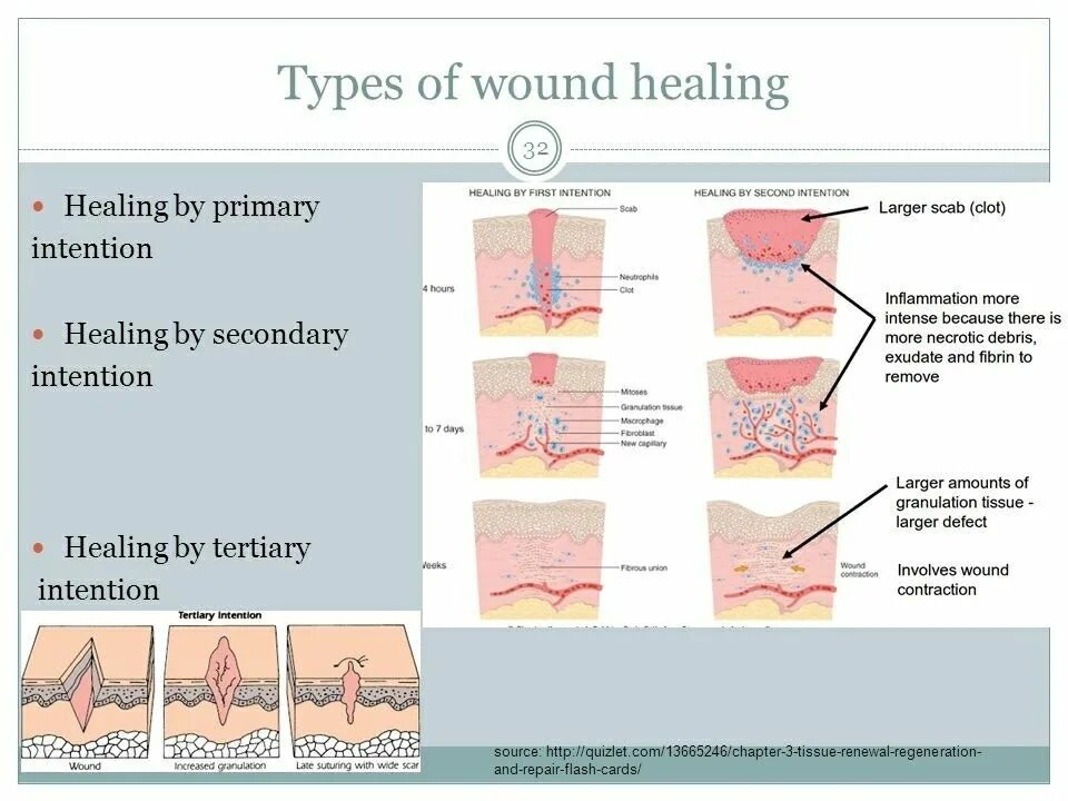 Types of wound. Types of wound