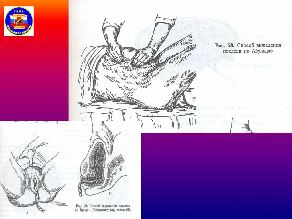 Способы выделения последа. Абуладзе гентера креде-лазаревича. Методы выделения отделившегося последа алгоритм. Способы выделения последа. Способы выделения последа.