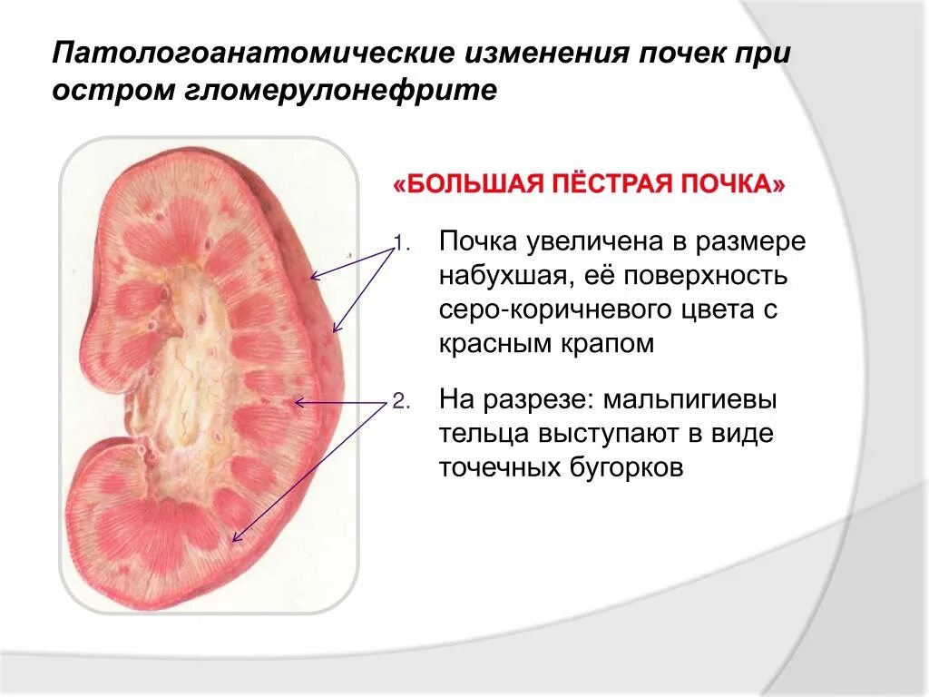 Патоморфологические изменения в почках при остром гломерулонефрите. Острый гломерулонефрит макропрепарат. Гломерулонефрит почки макропрепарат. Почка при остром гломерулонефрите.