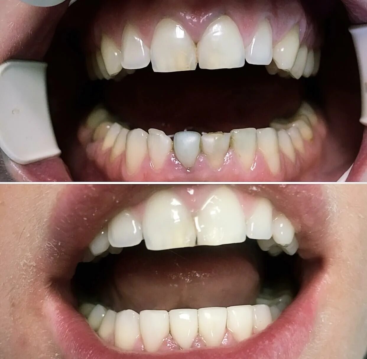 Лазерное отбеливание отзывы. Зубы после лазерного отбеливания. Лазерное отбеливание зубов до и после.