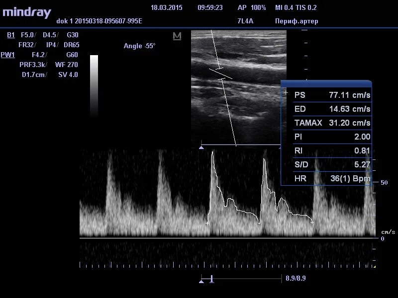 Цдс бца. Бца узи сосудов головного мозга. Ультразвуковое триплексное сканирование. Цдс бца. Узд бахицефальных артерий.