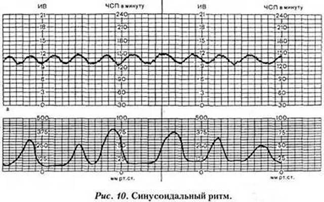 Синусоидальное ктг. Синусоидальный ритм на ктг у плода. Ктг-э-3. Синусоидальное ктг. Синусоидальное ктг.