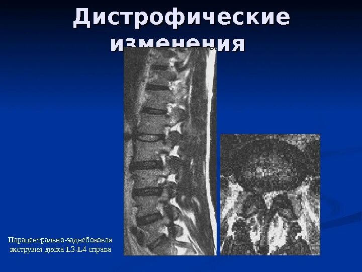 Дистрофические изменения позвоночника