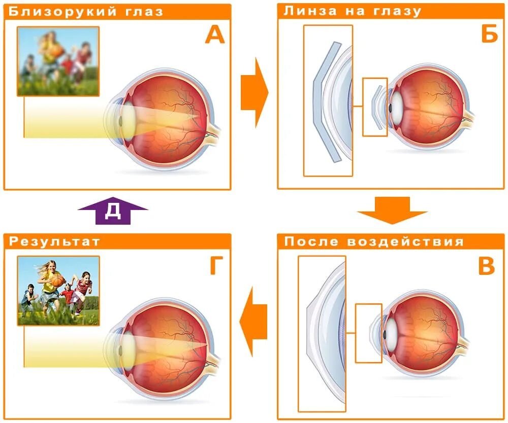 Как можно скорректировать зрение при помощи линз. Принцип работы ночных линз для коррекции зрения. Принцип работы ночных линз. Ортокератологические линзы. Линзы для коррекции миопии.