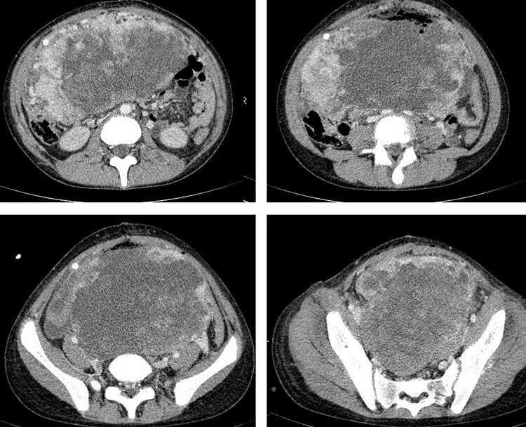 Тератома малого таза мрт. Кт и мрт при опухоли яичника. Рак яичника мрт