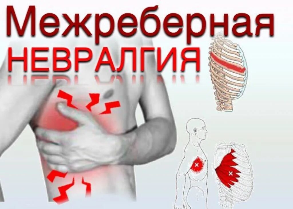 Межребеберная неврология. Иежребнрная неврология. Межрёберная нерволорги. Межоебергач неврология. Чем снять межреберную невралгию