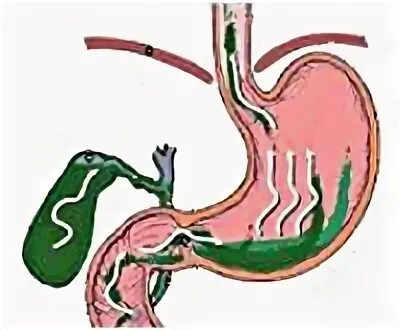 Дуоденальное билиарный рефлюкс. Дуоденальный гастрит рефлюкс. Дуоденально-гастральный рефлюкс желчи. ДГР. Дуодено-гастральный рефлюкс.. Рефлюкс дуоденогастральный симптомы