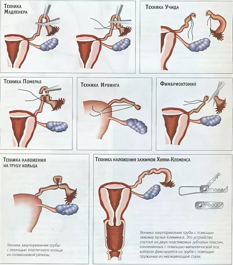 Мадленеру стерилизация маточных труб. Хирургический метод стерилизации женщине. Хирургическая стерилизация маточных труб. Если месячные если перевязать трубы