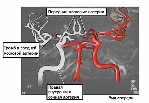 Тромбоз средней мозговой артерии. Трифуркация внутренней сонной артерии. Гипоплазия внутренней сонной артерии кт. Аплазия позвоночной артерии. Тромбоз мозговых сосудов