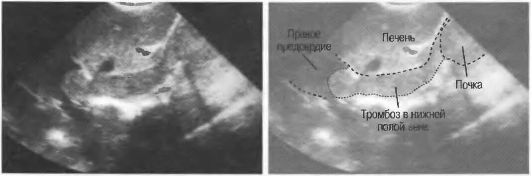 Тромбоз нижней полой вены на УЗИ. Тромбоз почечной вены УЗИ. Тромб в нижней полой Вене на УЗИ. Тромбоз почечной вены