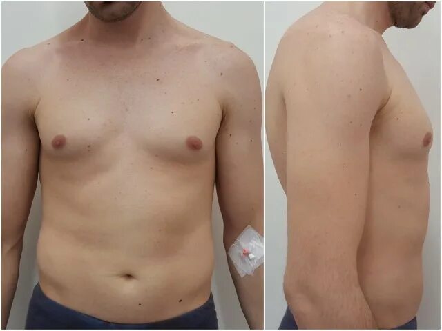 недельный новорожденный. юношеская гинекомастия. у мальчика набухли молочные. растущая грудь. молочные железы у мальчиков.