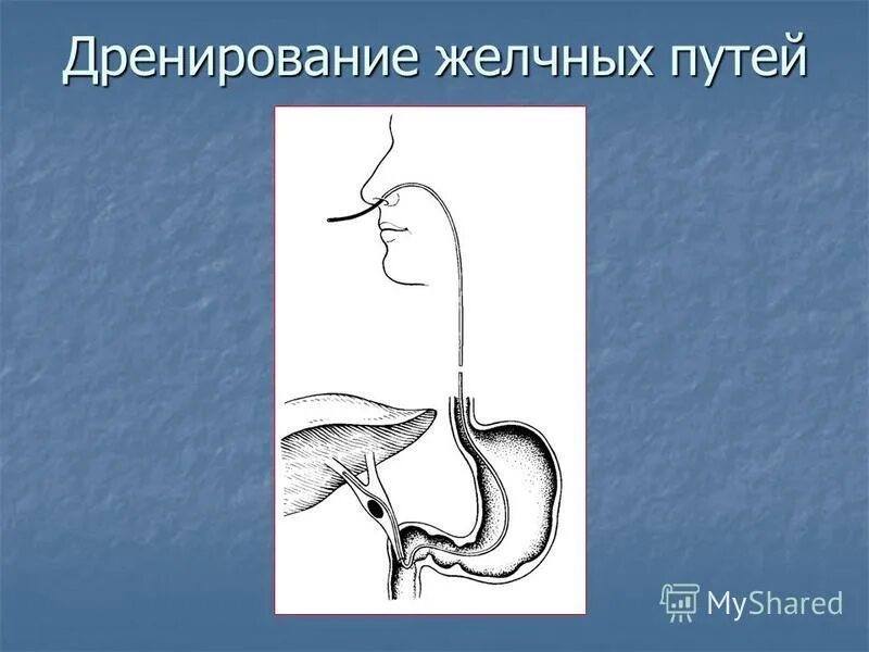 наружное дренирование желчных протоков. методы внутреннего дренирования желчных протоков. дренирование желчных протоков при механической желтухе. внутреннее дренирование холедоха. дренирование желчных путей по пиковскому.