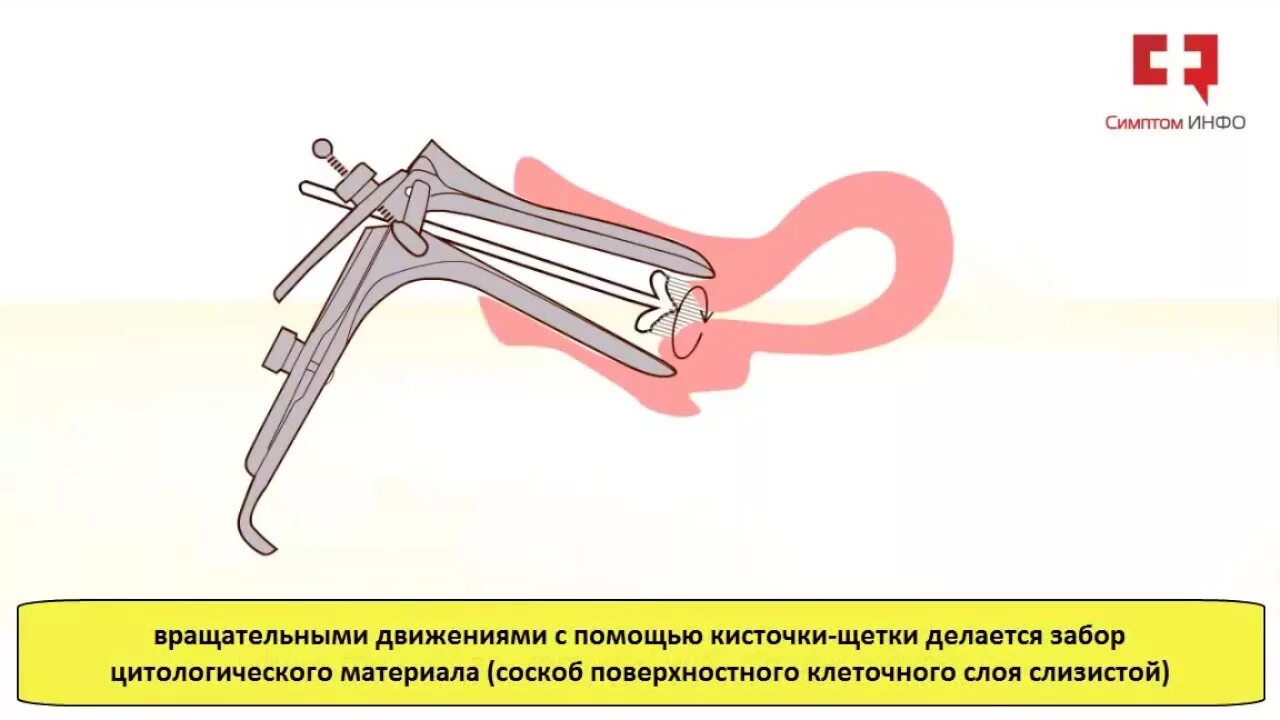 Гинекологическое зеркало схема. Взятие мазка по Папаниколау (PAP-тест, цитологическое исследование). Пап тест шейки