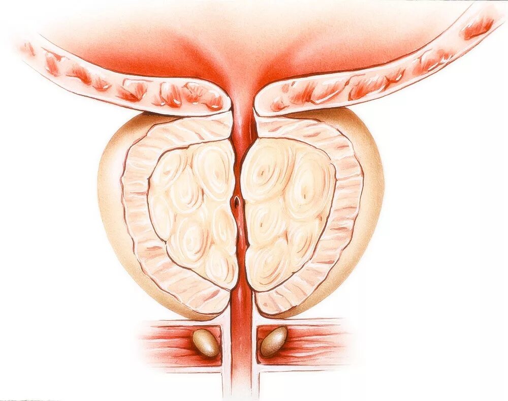 Как выглядит предстательная железа. Как выглядит предстательная железа. Злокачественная опухоль предстательной железы. Аденома предстательной железы – это опухоль. Анатомия аденомы предстательной железы.