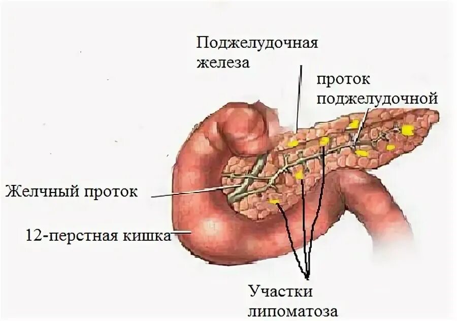 Структурные изменения поджелудочной. Липоматозное изменение поджелудочной железы. Хронический панкреатит липоматоз. Липоматоз поджелудочной железы лекарства. Панкреатит липоматоз поджелудочной железы.