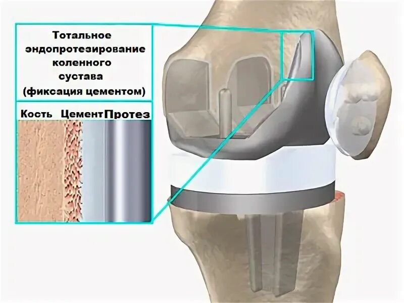 Тотальное эндопротезирование коленного сустава DEPUY. Эндопротез коленного сустава Maxx Orthopedics. Тибиальный компонент эндопротеза коленного сустава. Цементная фиксация эндопротеза тазобедренного сустава.