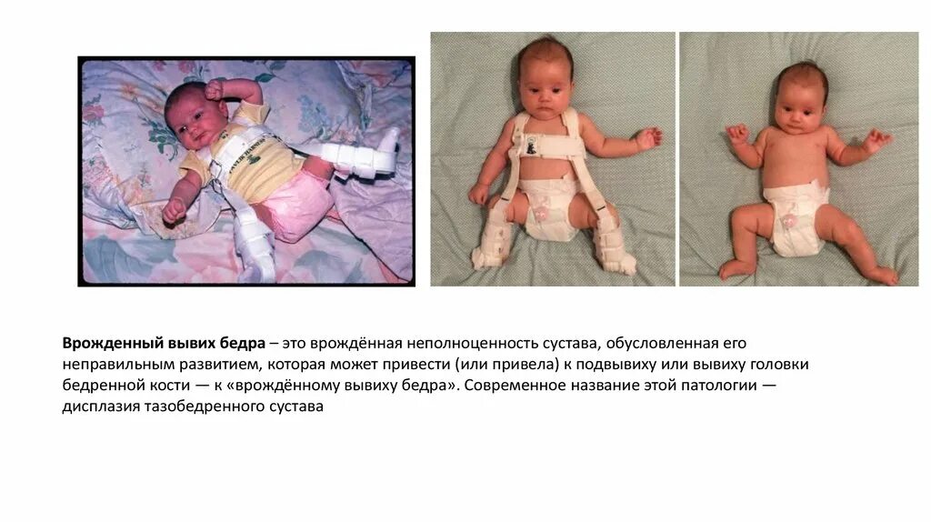 Дисплазия сустава у новорожденного лечение. Врожденный вывих бедра и дисплазия тазобедренного сустава. Дисплазия вывих тазобедренного сустава. Врождённый вывих тазобедренного сустава у новорожденного. Диагноз дисплазия тазобедренного сустава.