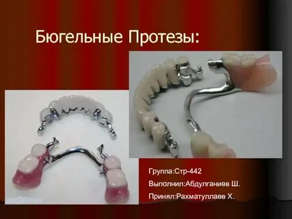 Бюгельный протез дипломная работа