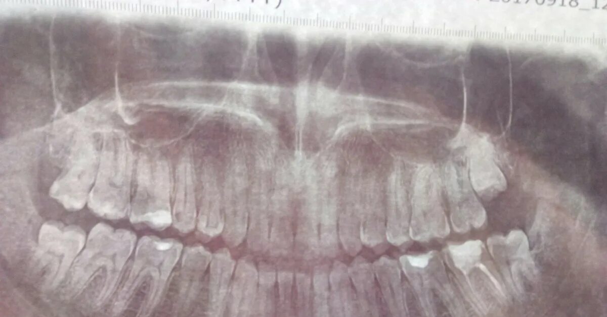 Eight teeth